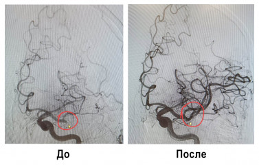 в КБСМП выполнена первая в Смоленской области тромбаспирация - фото - 3