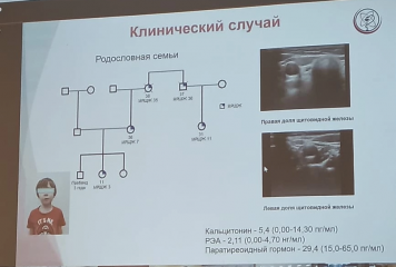 клинический случай лечения медуллярного рака щитовидной железы в рамках синдрома МЭН 21 - фото - 1